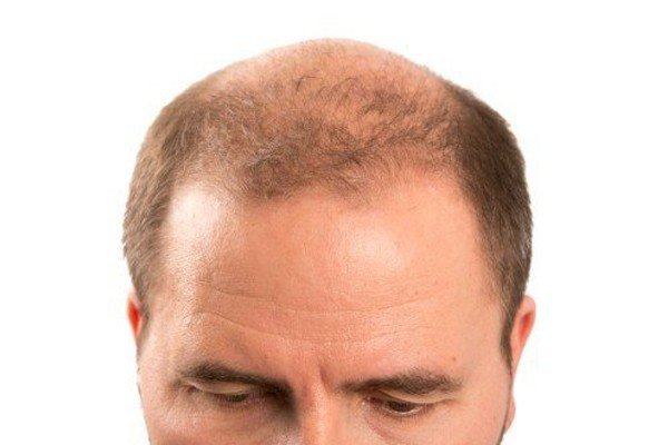 7 Stages of Male Pattern Baldness You Should Know 1